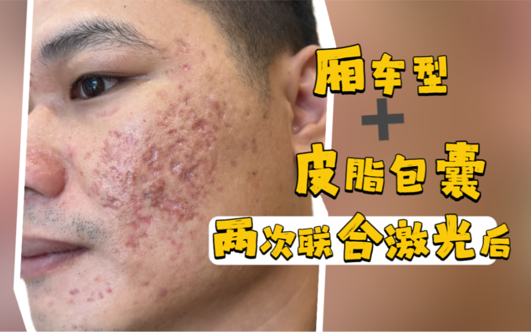 补硒治下巴痘（下巴长痘吃维生素b还是c）-硒宝网