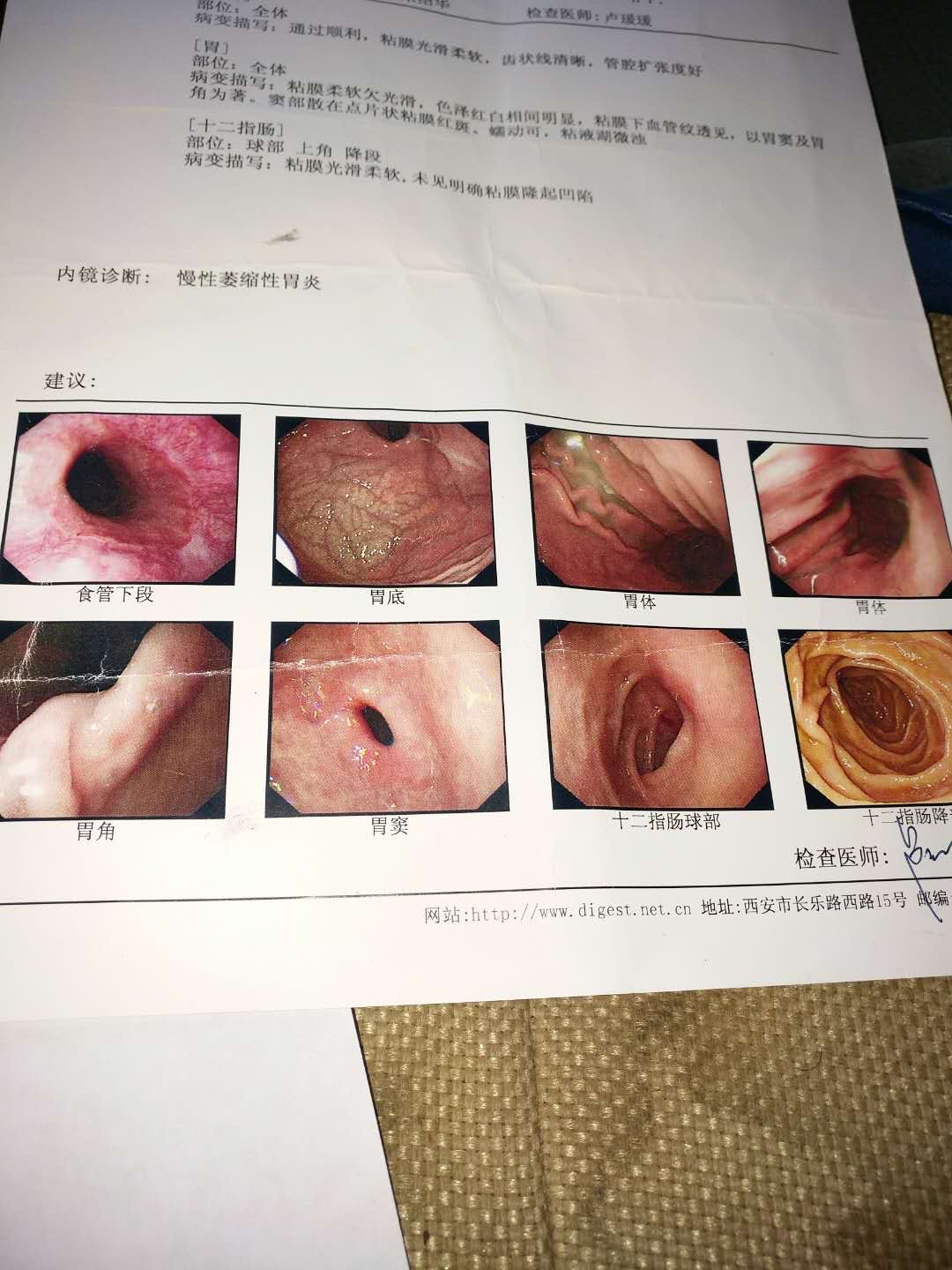 甲亢要补硒么（甲亢补硒补多久）-硒宝网