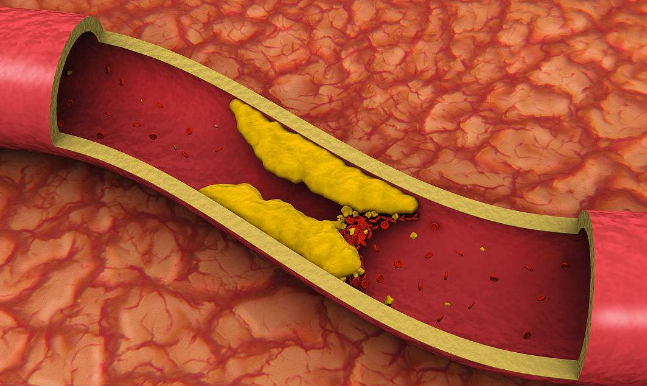 血脂高要补硒(补硒可以降血脂吗)-硒宝网
