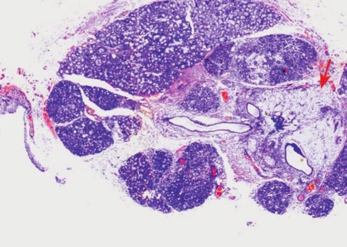 补硒对类风湿(类风湿关节炎补硒的真实效果)-硒宝网