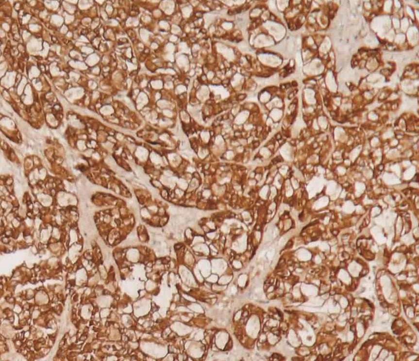 补硒对类风湿(类风湿关节炎补硒的真实效果)-硒宝网