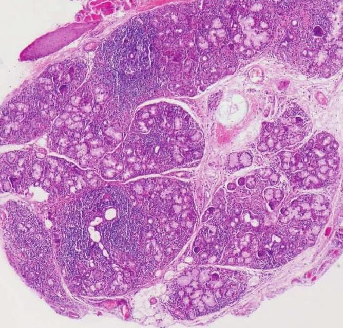 补硒对类风湿(类风湿关节炎补硒的真实效果)-硒宝网