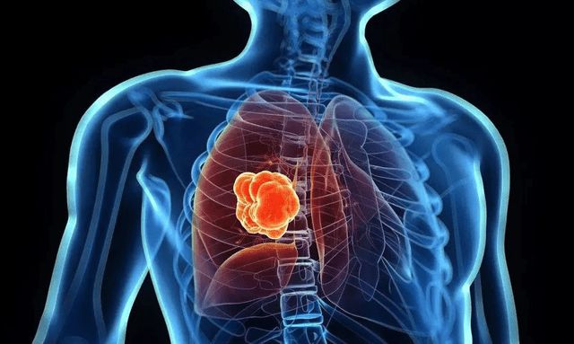 肺结节与补硒(硒对肺结节有作用吗)-硒宝网