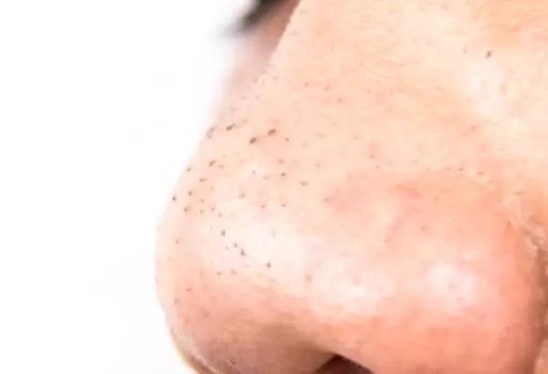 补硒会变黑么（硒变黑怎么回事）-硒宝网