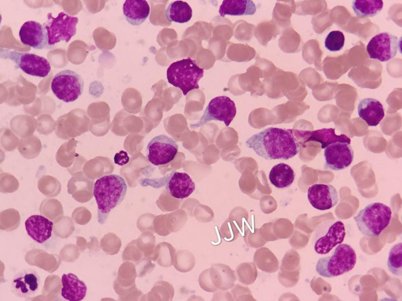 白血病人补硒（白血病补硒人会变瘦吗）-硒宝网