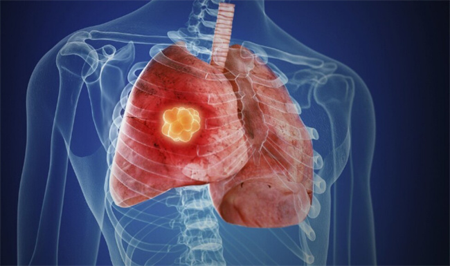 肺炎能补硒吗(硒对肺炎的原理)-硒宝网