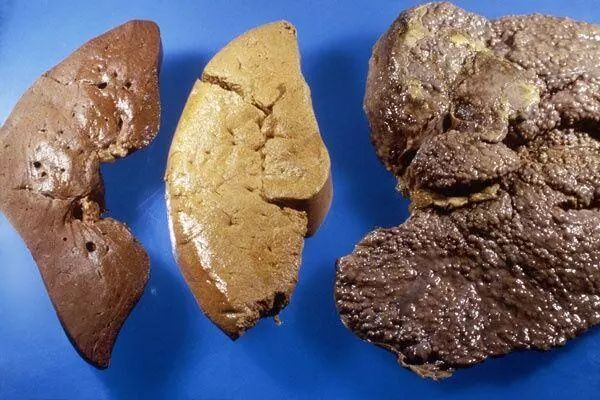 乙肝患者补硒(补患者乙肝硒片吃多久)-硒宝网