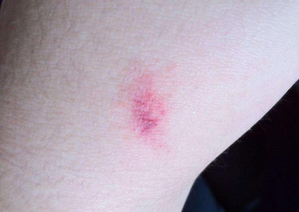 患癌患者补硒（补硒对癌症患者有用么）-硒宝网