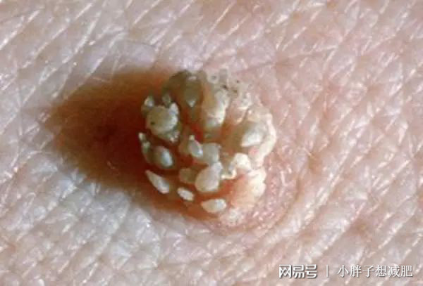 补硒去丝状疣(丝状疣涂抹什么药)-硒宝网