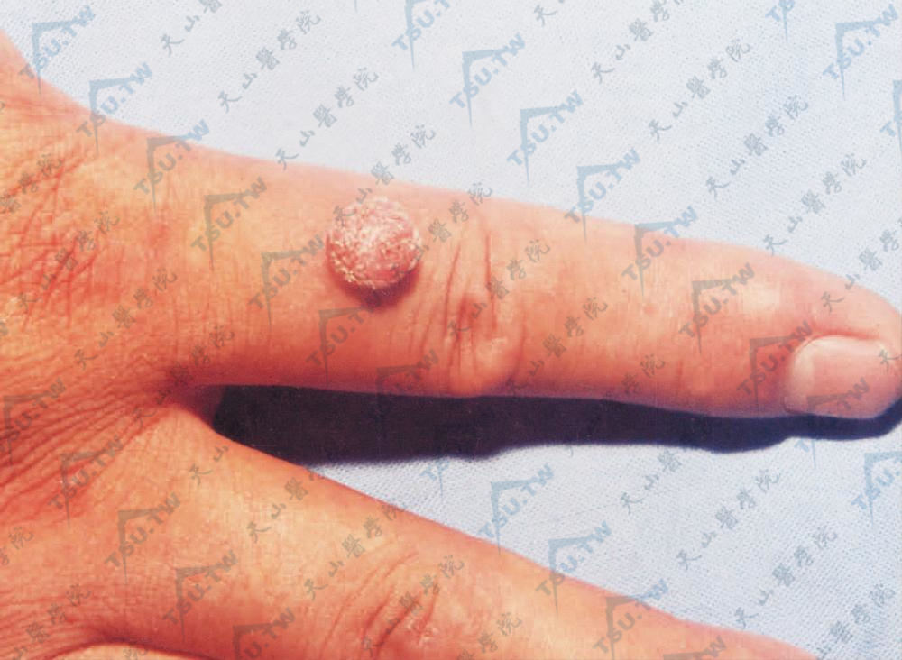 补硒去丝状疣(丝状疣体脱落用什么药膏)-硒宝网