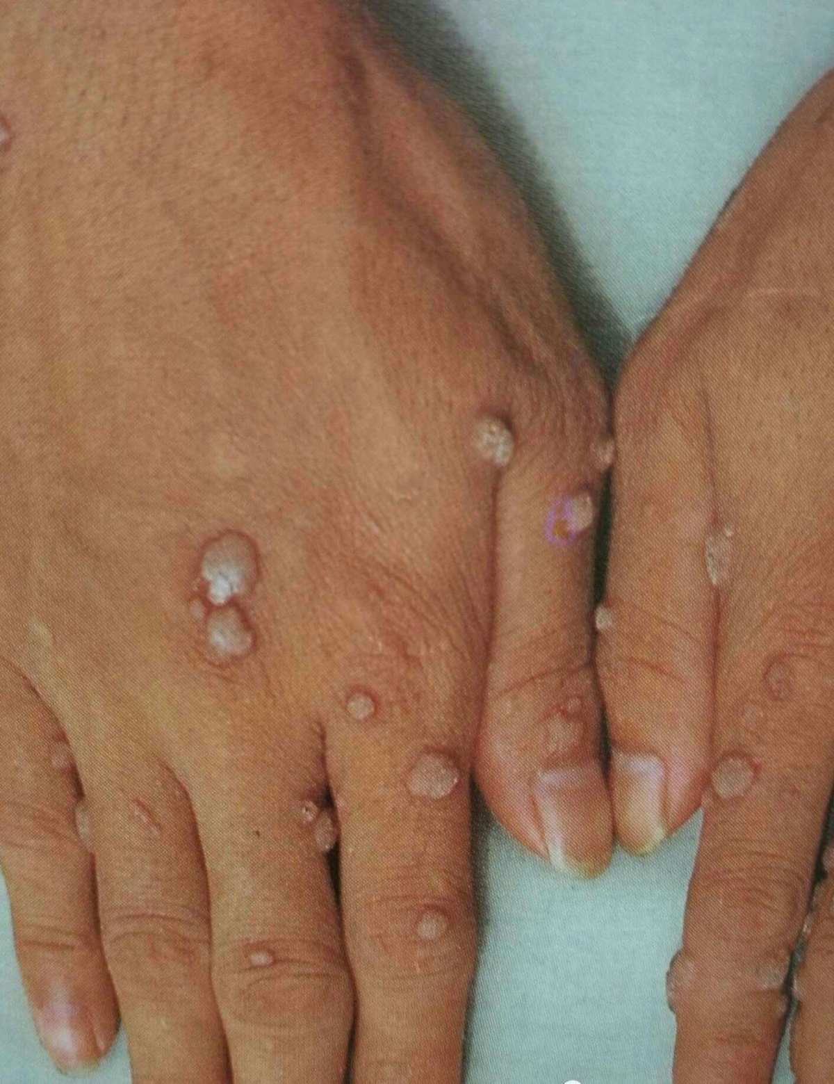 补硒去丝状疣(丝状疣体脱落用什么药膏)-硒宝网