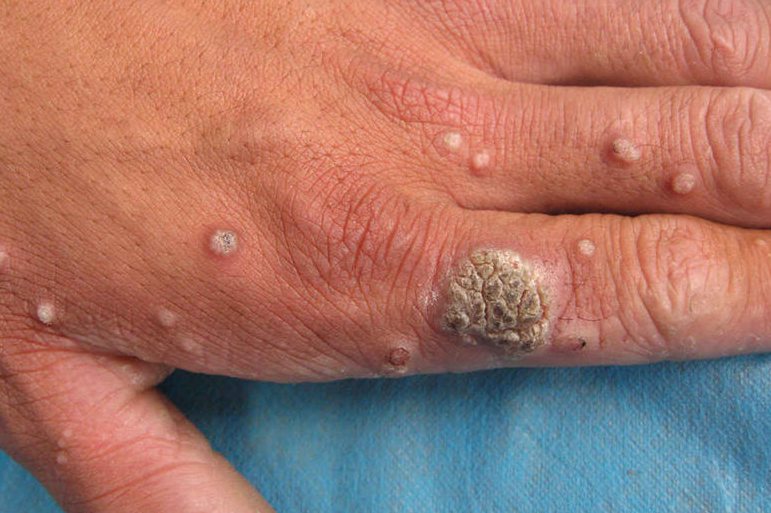 补硒去丝状疣(丝状疣体脱落用什么药膏)-硒宝网