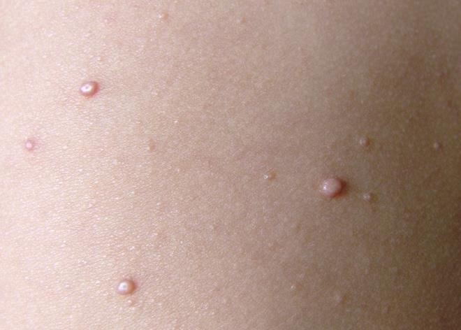 补硒去丝状疣(丝状疣体脱落用什么药膏)-硒宝网