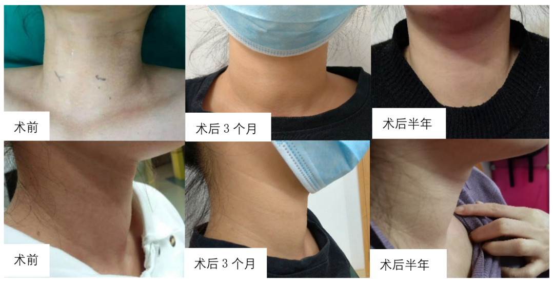 甲亢眼突补硒（甲亢突眼硒酵母）-硒宝网