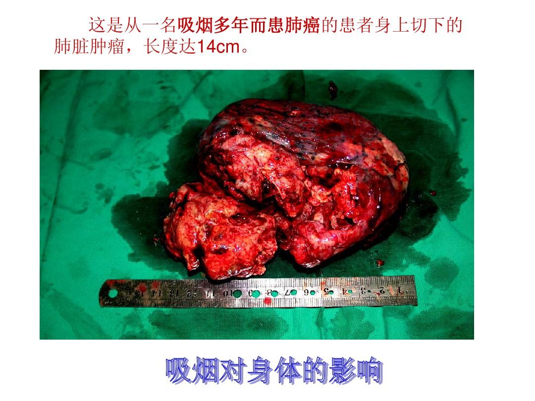 食道癌 补硒(硒食道癌)-硒宝网