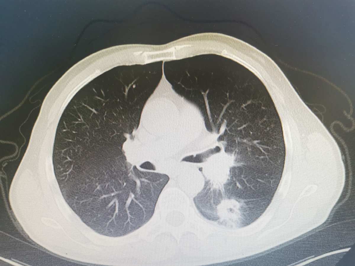 食道癌 补硒(硒食道癌)-硒宝网