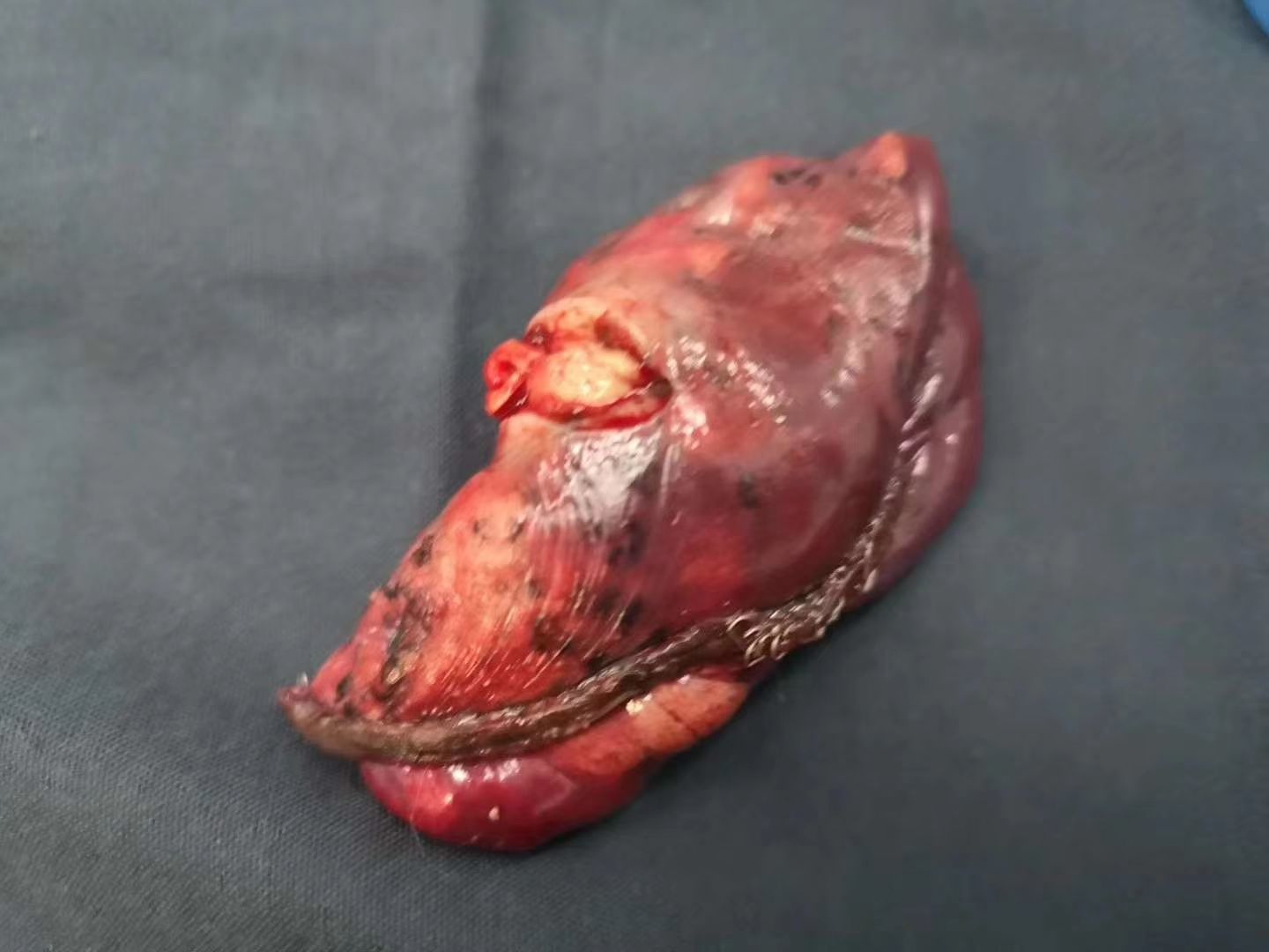 食道癌 补硒(硒食道癌)-硒宝网