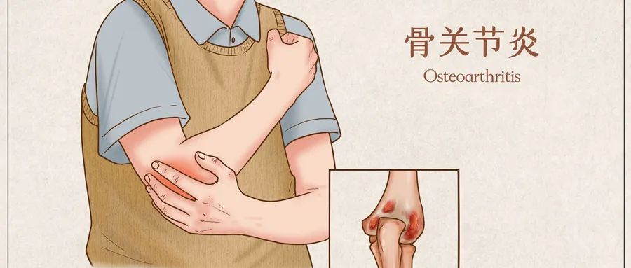 补硒与关节痛(硒对关节炎疼痛的作用)-硒宝网