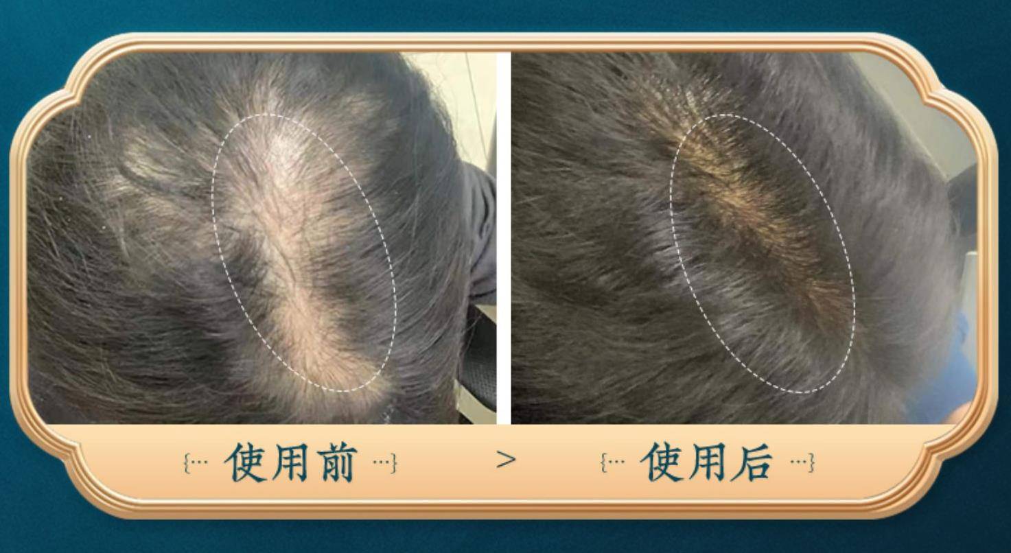 补硒会掉头发(掉补头发硒会长头发吗)-硒宝网