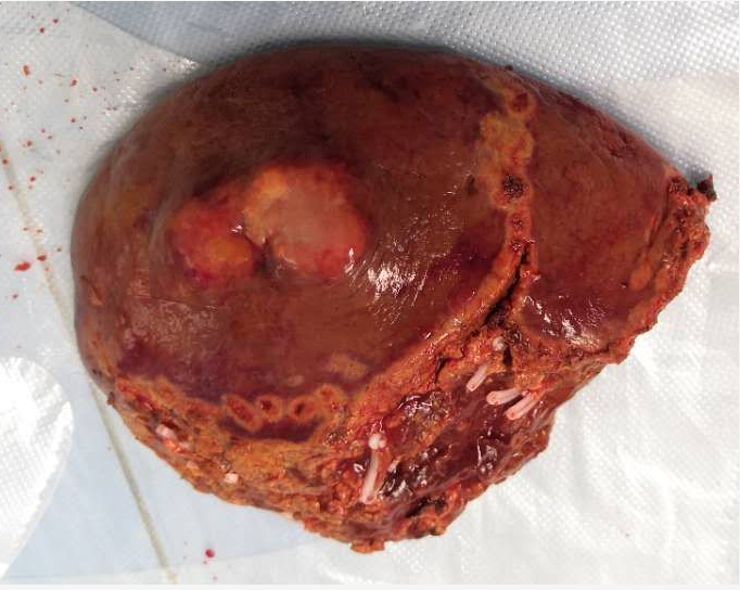 补硒后肝区疼（补硒肝脏）-硒宝网