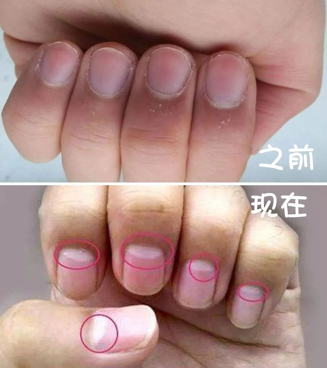 每天补一粒硒(每天补硒后肝脏变化案例)-硒宝网