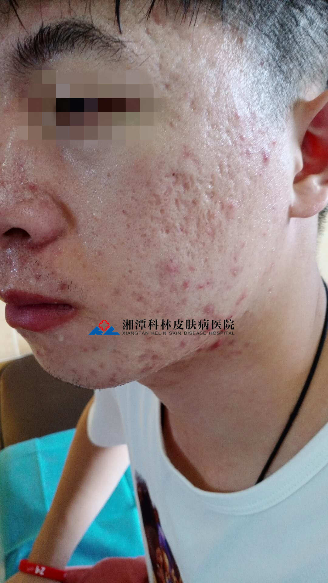 胃寒能补硒吗（硒对胃病的作用）-硒宝网