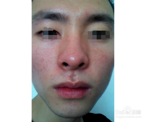 脂肪肝能补硒（肝脂肪能补硒嘛）-硒宝网