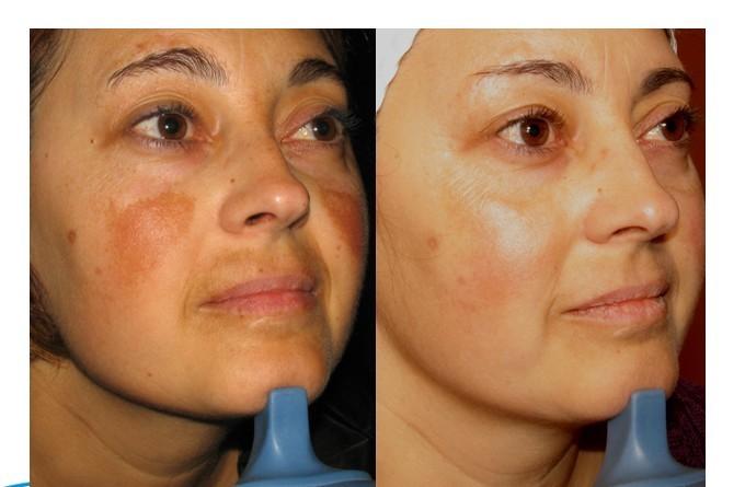 脂肪肝能补硒（肝脂肪能补硒嘛）-硒宝网