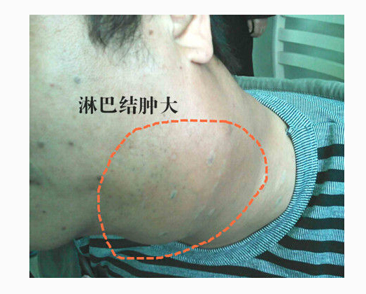 淋巴瘤补硒吗(补硒对淋巴结肿大有影响吗)-硒宝网