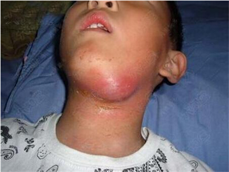 淋巴瘤补硒吗(淋巴瘤补硒有效果吗)-硒宝网