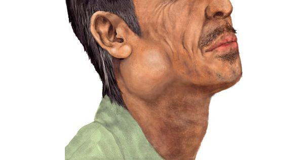 淋巴瘤补硒吗(淋巴瘤补硒有效果吗)-硒宝网