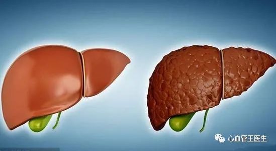 硒补脂肪肝吗（脂肪肝吃硒有什么用）-硒宝网