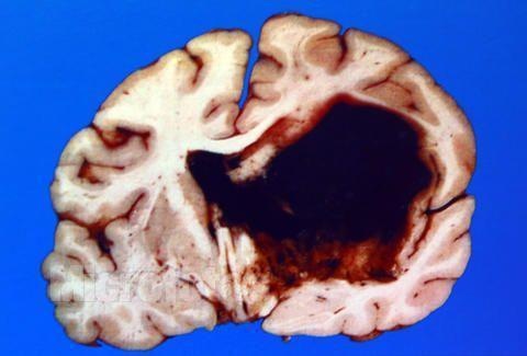 富硒茶高血压(硒对高血压)-硒宝网