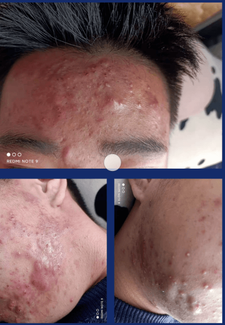 女生补锌会增加雌性激素吗(女生补雌性激素的影响)-硒宝网