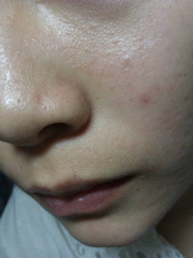 女生补锌会增加雌性激素吗(女生补雌性激素的影响)-硒宝网