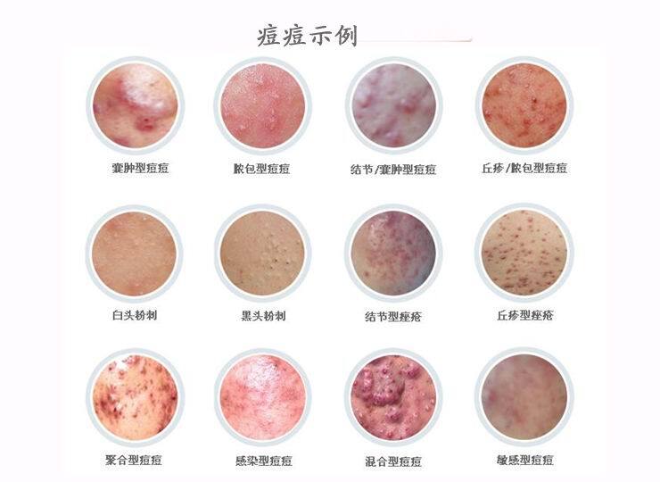 脸上有痤疮要补锌多久(痤疮脸上补锌要有激素吗)-硒宝网