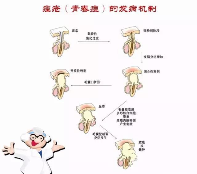 脸上有痤疮要补锌多久(痤疮脸上补锌要有激素吗)-硒宝网