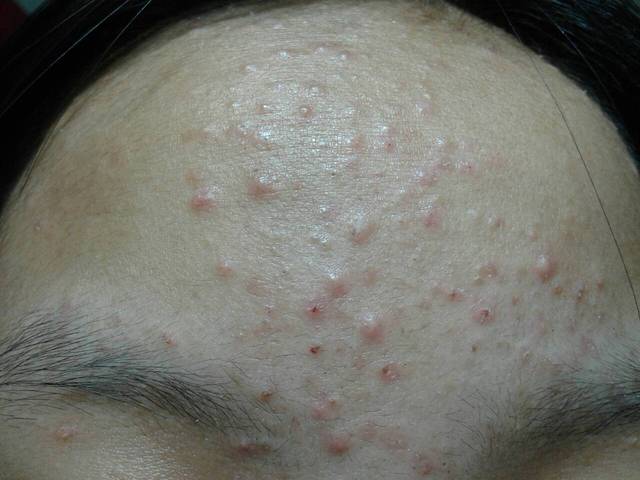 脸上有痤疮要补锌多久（痤疮脸上补锌要有什么作用）-硒宝网