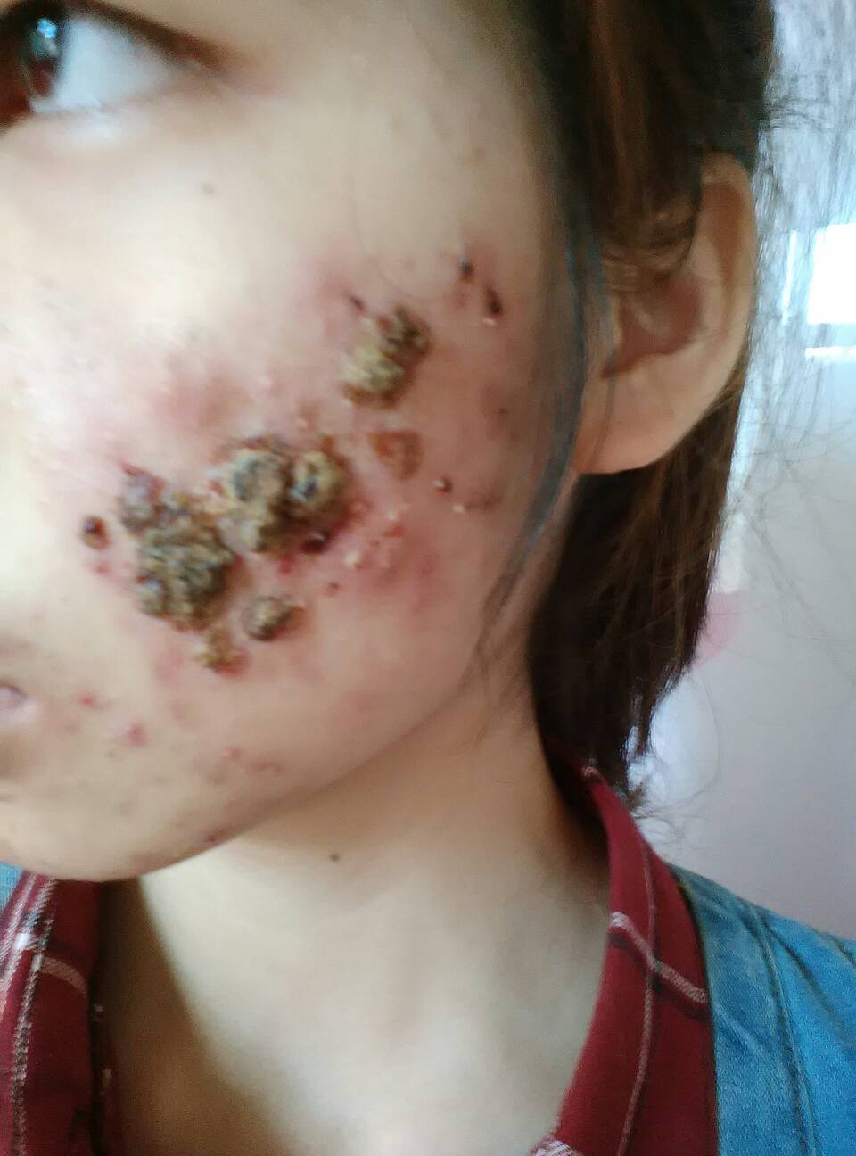 脸上有痤疮要补锌多久（痤疮脸上补锌要有什么作用）-硒宝网