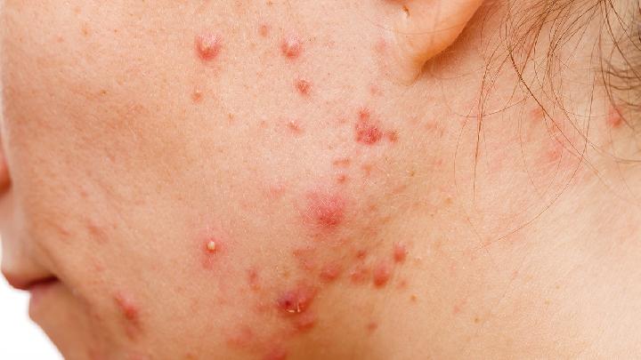 脸上有痤疮要补锌多久（痤疮脸上补锌要有什么作用）-硒宝网