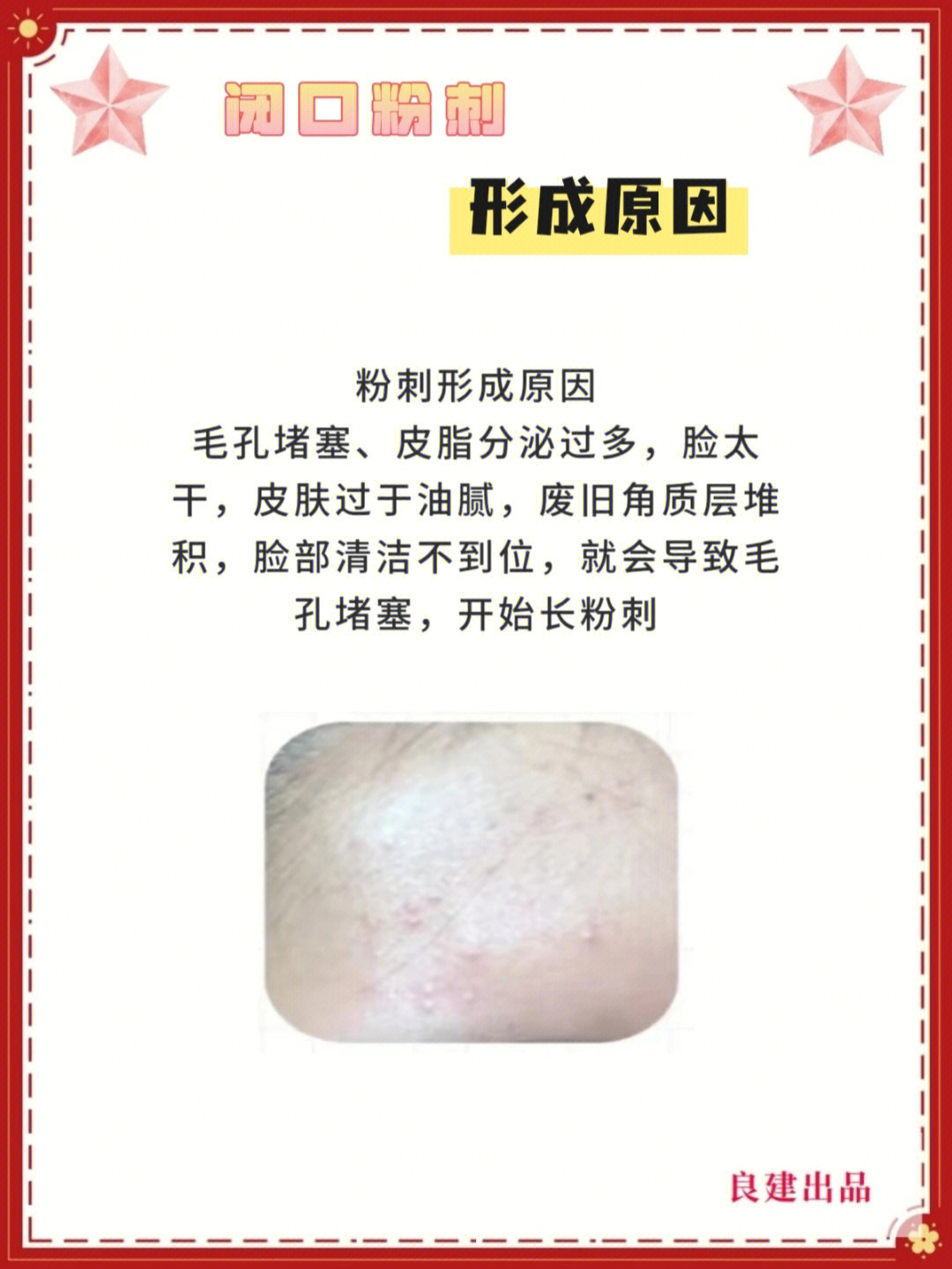 脸上有痤疮要补锌多久(痤疮补锌有用吗)-硒宝网