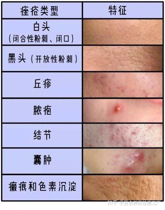 脸上有痤疮要补锌多久(痤疮补锌有用吗)-硒宝网