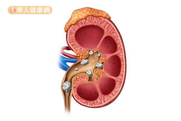 补钙过量会有什么症状(过量补钙会导致什么)-硒宝网