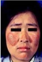 锌硒宝高血压（有高血压能吃锌和硒吗）-硒宝网