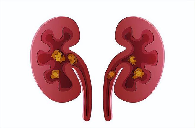 有肾结石可以补钙吗(肾结石补钙可以吃维生素k2吗)-硒宝网