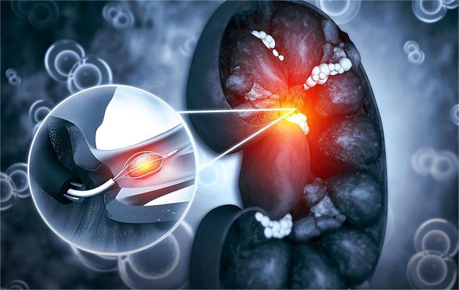 有肾结石可以补钙吗(肾结石补钙可以吃维生素k2吗)-硒宝网