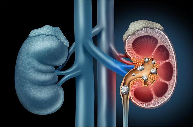 有肾结石可以补钙吗(肾结石补钙可以吃维生素k2吗)-硒宝网