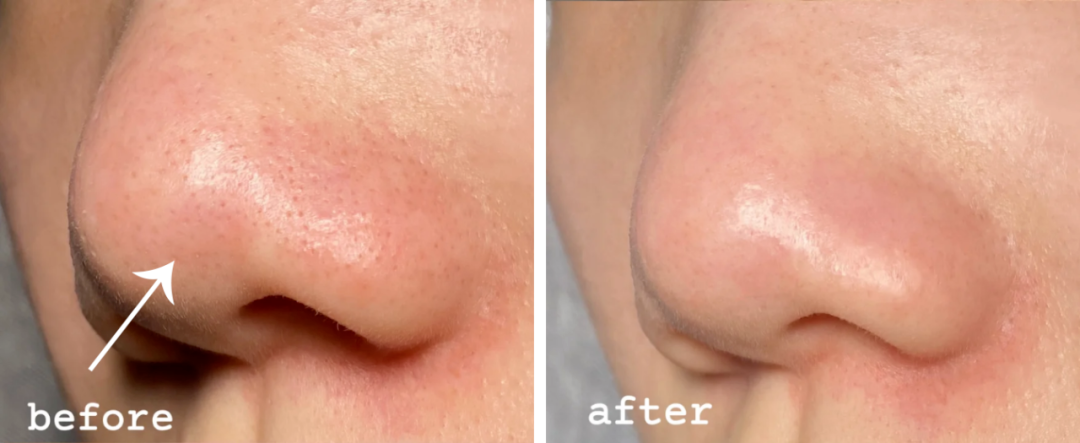 锌硒宝治痘痘(锌能治痘痘吗)-硒宝网