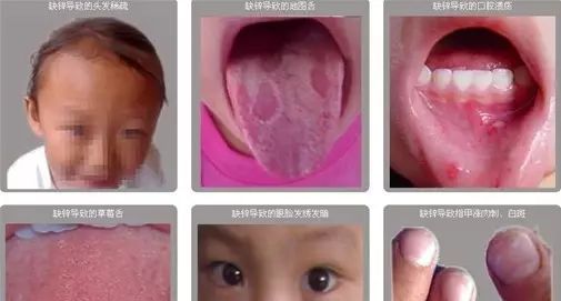 吃了锌硒宝片(吃锌硒宝片有什么功效)-硒宝网