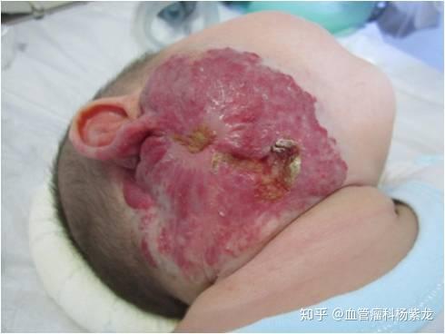 锌硒宝治疗病（锌硒宝有效果吗）-硒宝网